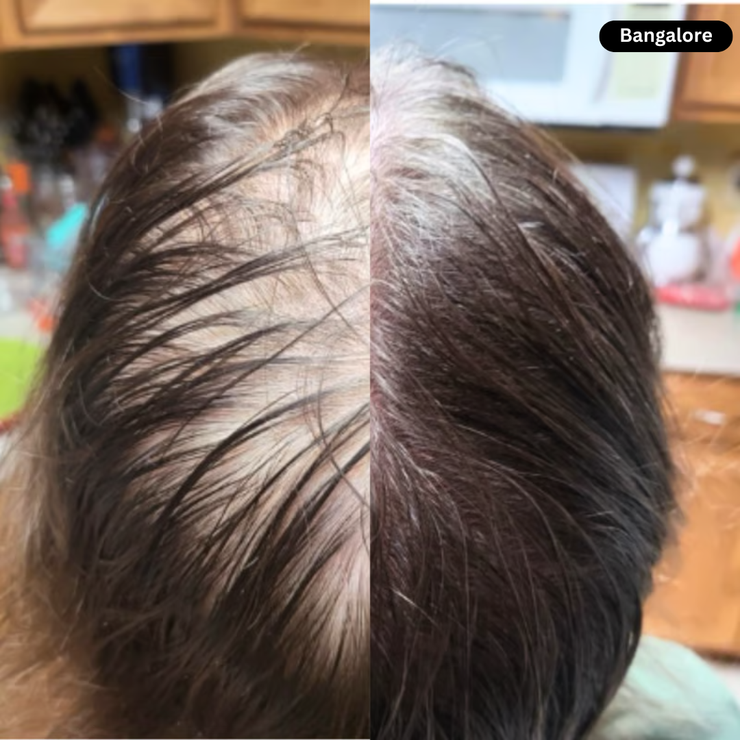 Hair Regrowth Red Light Therapy Hat.(If Its Not Working ,100% Money Back Guarantee)