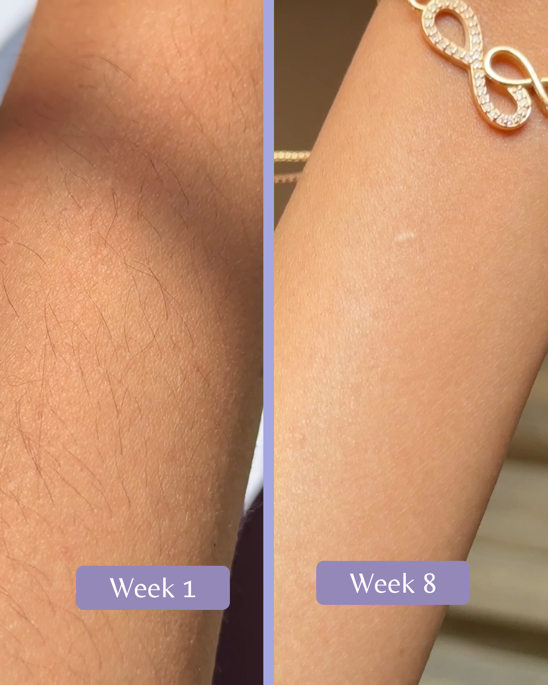 Serenity IPL Hair Removal Handset